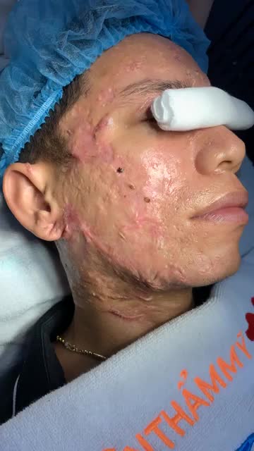 Điều trị SẸO LỒI biến dạng toàn mặt LẦN 2