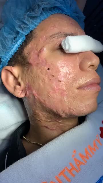 Điều trị SẸO LỒI biến dạng toàn mặt LẦN 2