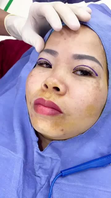 Đo vẽ - tư vấn trực tiếp với bác sĩ trước CẮT MÍ PLASMA