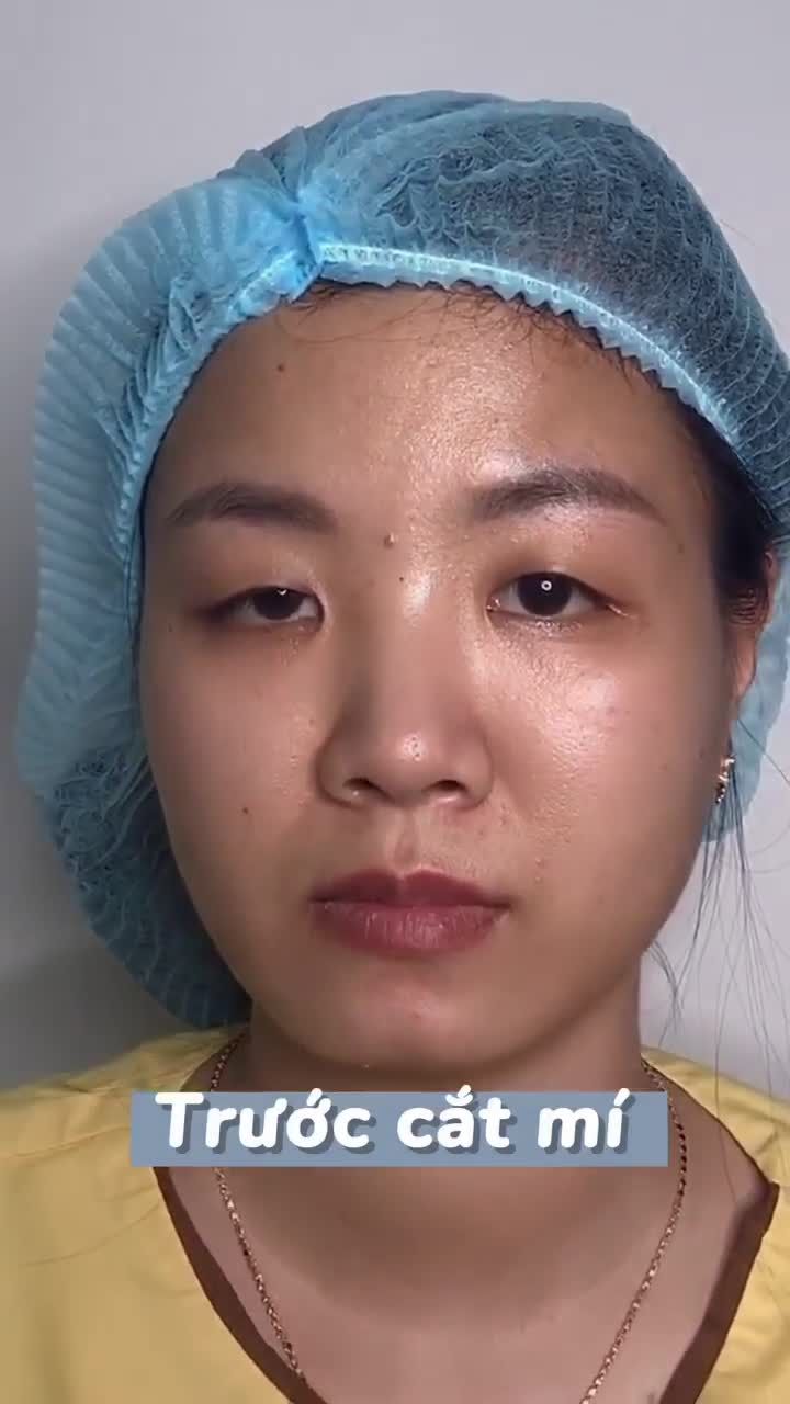 Dr.Hải Lê có thể chỉnh hình giúp khách hàng khắc phục tình trạng sụp mí bẩm sinh đạt kết quả đến 80% ngay sau khi thực hiện