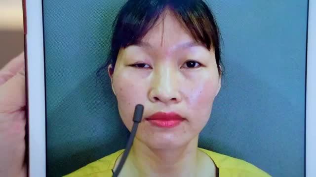 Đứt cơ nâng mi gây liệt cơ sau cắt mí tại cơ sở không uy tín