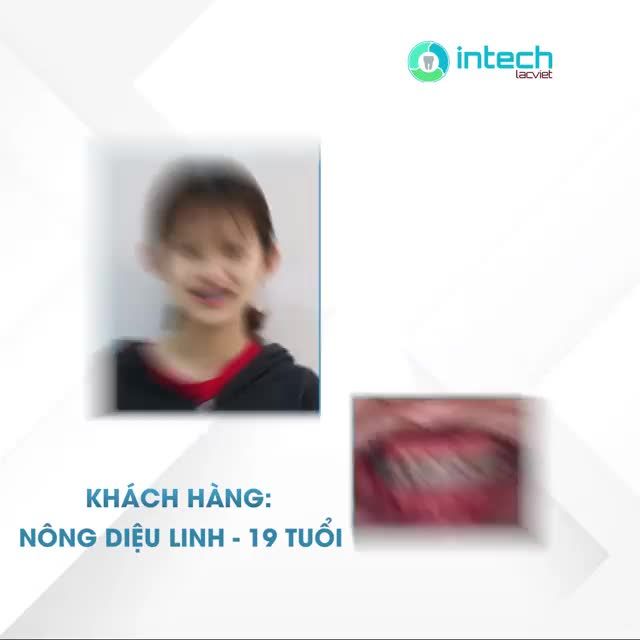 EM ĐÃ KHÔNG CÒN TỰ TI KHI CƯỜI VÌ HÀM RĂNG MÓM NỮA