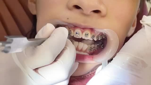 Gắn mắc cài cho bệnh nhân răng Hô - chen chúc