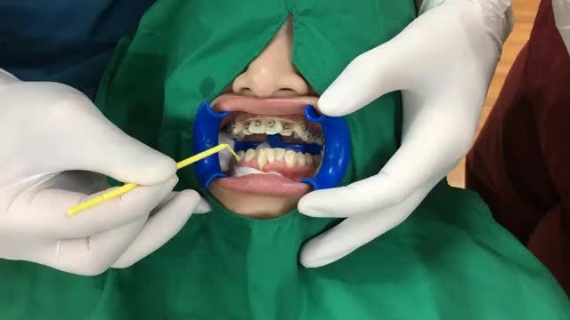 Gắn mắc cài điều trị răng chen chúc khấp khểnh cho bạn khách hàng nữ tại Nha Khoa Thuỳ Anh