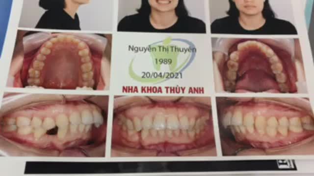 Gắn mắc cài điều trị răng hô cho chị Thuyên.