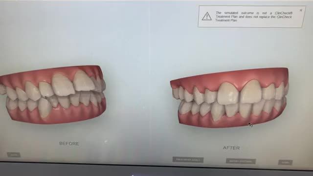Gắn mắc cài điều trị răng hô, lệch lạc cho chị Hảo tại nha khoa Thùy Anh.