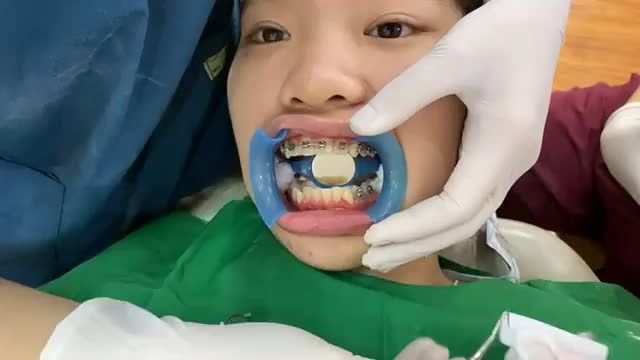Gắn mắc cài hàm dưới cho bạn Linh tại nha khoa Thuỳ Anh