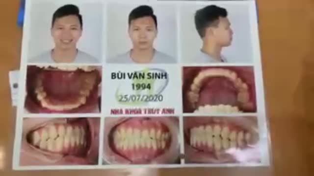 Gắn mắc cài hàm trên cho anh Bùi Văn Sinh điều trị tình trạng cắn ngược, lệch mặt.