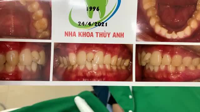gắn mắc cài niềng răng, tình trạng răng kẹ mọc thừa ở giữa răng cửa, ảnh hưởng xấu đến thẩm mỹ nụ cười!