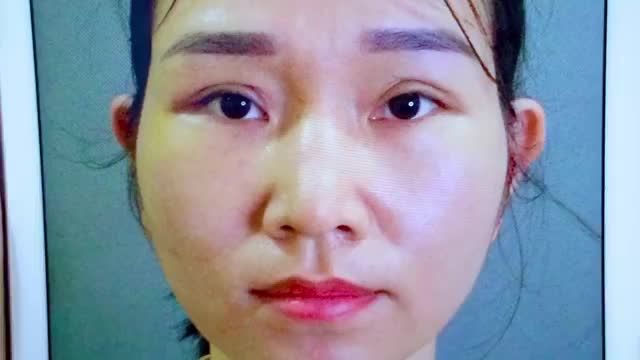 GIẢI CỨU CA NHẤN MÍ HỎNG NẶNG CƯỜNG CƠ NÂNG MI SAU 2 THÁNG THỰC HIỆN MỜI QUÝ KHÁCH HÀNG CÙNG THEO DÕI