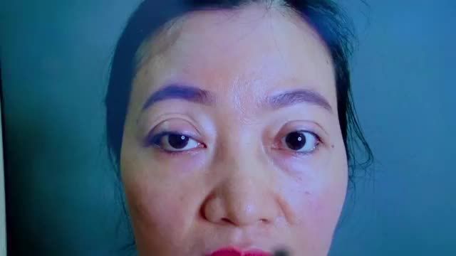 GIẢI CỨU MÍ LỖI HỎNG NẶNG do thực hiện tại cơ sở không uy tín
