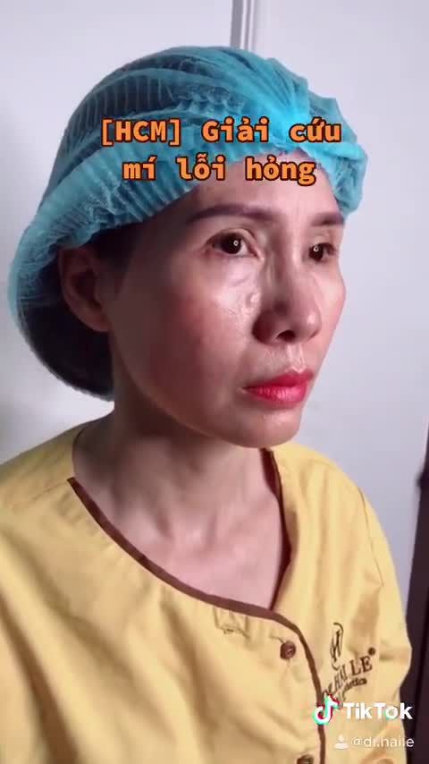 Giải cứu mí lỗi hỏng sau 3 tháng thực hiện tại cơ sở không uy tín!