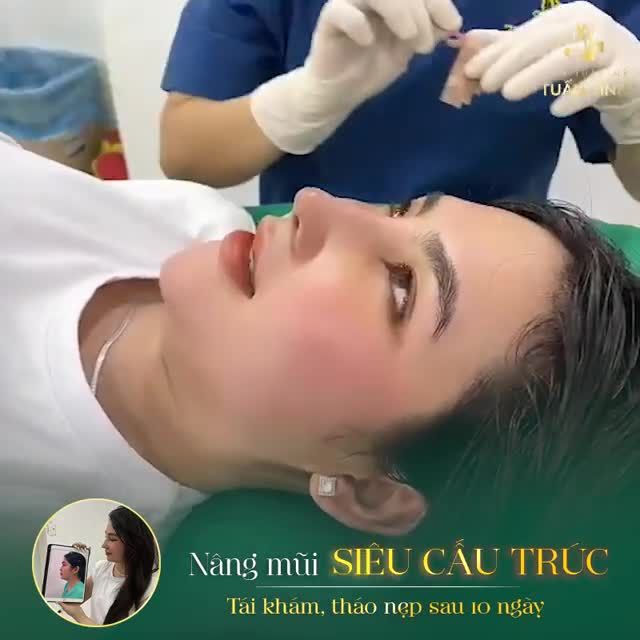 ''GIẢI MÃ'' THẮC MẮC CỦA KHÁCH HÀNG - NÂNG MŨI 10 NGÀY ĐÃ ĐẸP CHƯA?