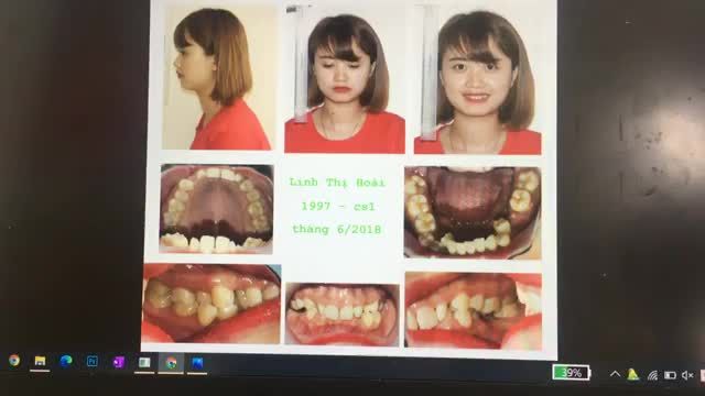 Giới thiệu sự thay đổi trên 1 ca chỉnh nha, niềng răng.