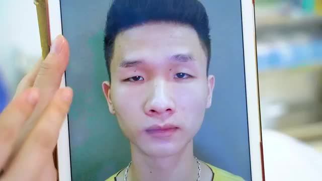 Giúp cậu sinh viên thoát khỏi tự ti suốt 20 năm sống chung với mắt sụp mí bẩm sinh