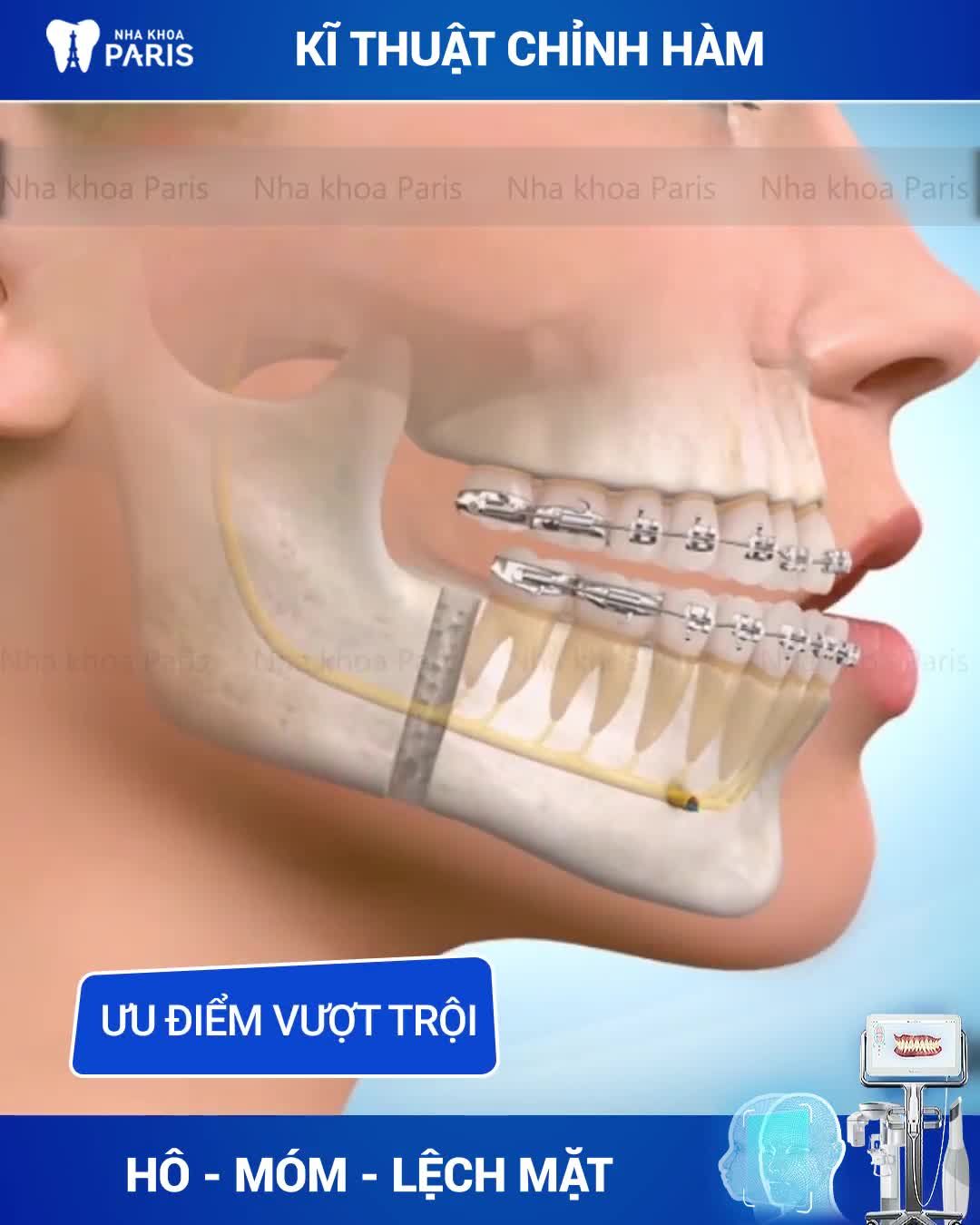 Hàm Hô - Hàm Móm - Mặt Lệch OFF 30% - Tài trợ 2TR phí đi lại