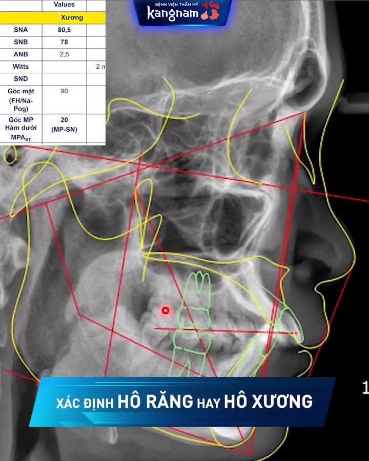 HÀM HÔ - MIỆNG VẨU
