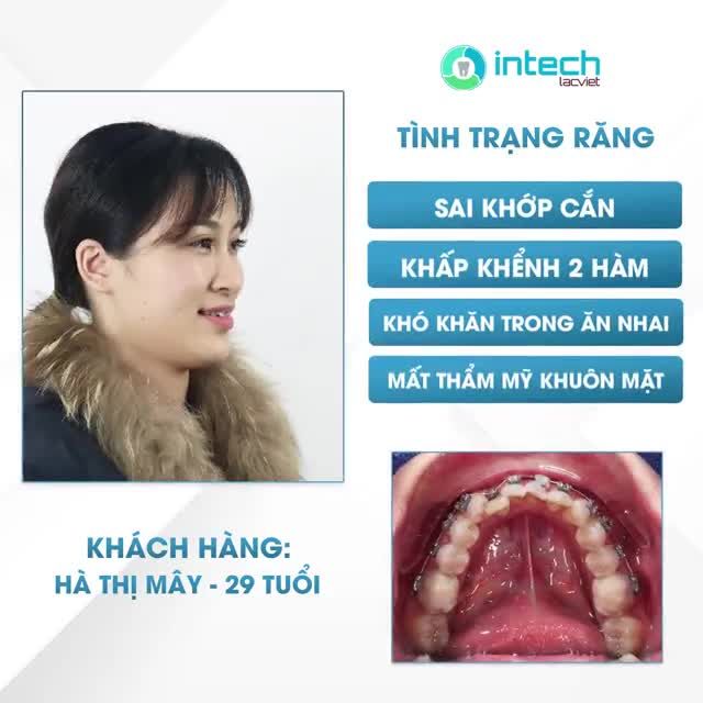 HÀM RĂNG KHẤP KHỂNH, CẮN SÂU ĐƯỢC THÁO NIỀNG SAU 1 NĂM 2 THÁNG