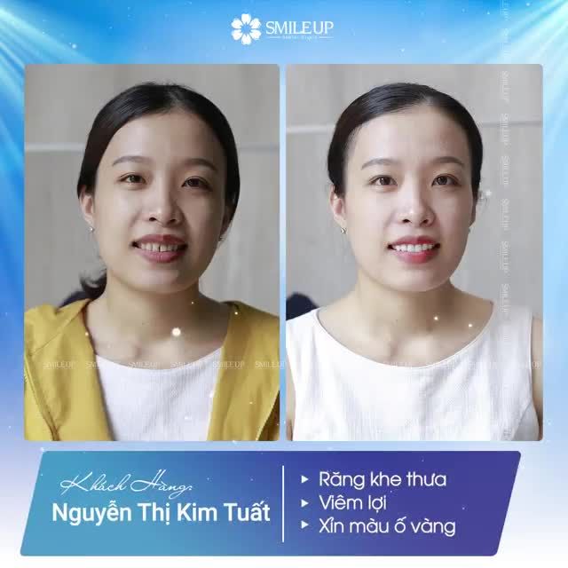 HÃNH DIỆN TẠO NÊN NHỮNG ĐƯỜNG CƯỜI DUYÊN DÁNG MANG NGÀN SẮC THÁI CÁ TÍNH