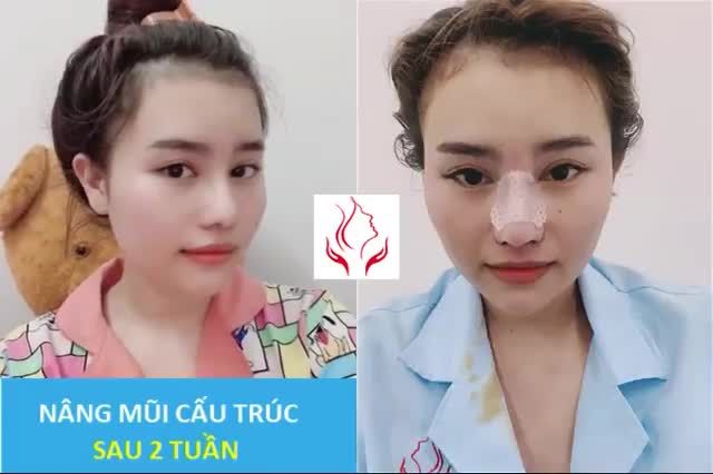 HẾT HỒN CHƯA??? LỘT XÁC SAU KHI NÂNG MŨI CẤU TRÚC TẠI DR.THÔNG