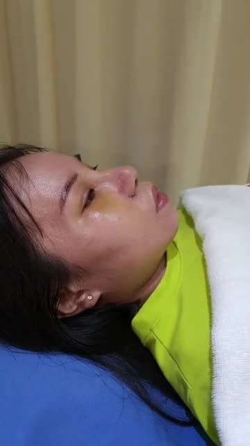Hướng dẫn NẸP MŨI- CÔNG ĐOẠN quan trọng bắt buộc phải có sau nâng mũi?