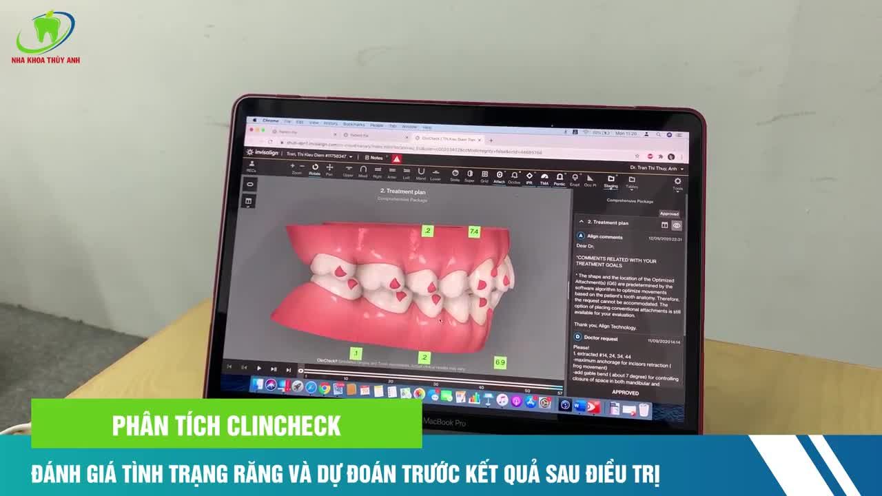 INVISALIGN - SỰ LỰA CHỌN TUYỆT VỜI CHO NHỮNG BẠN NIỀNG RĂNG