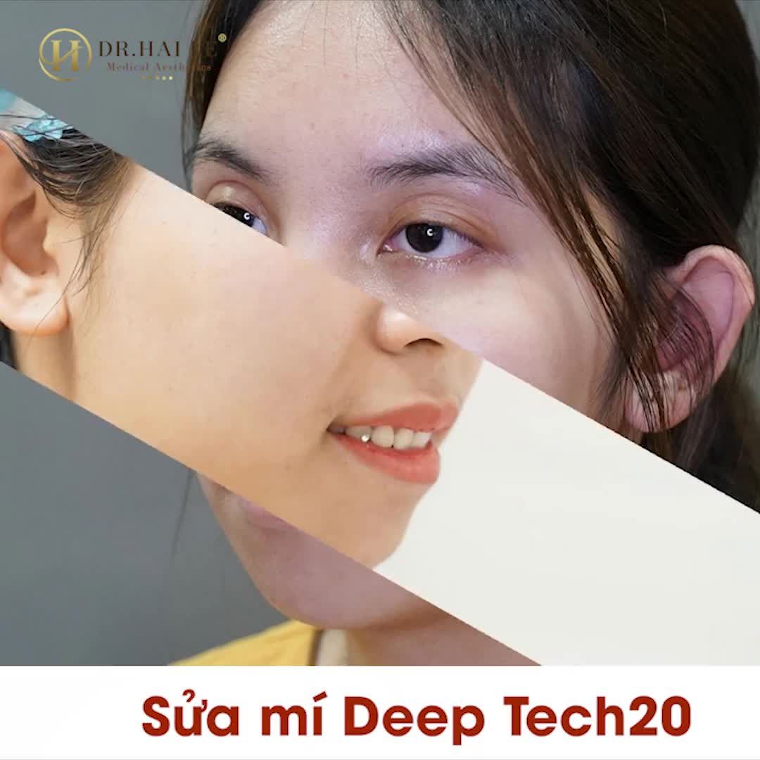 KẾT QUẢ 1H30P SỬA MÍ KỸ THUẬT DEEPTECH20 KHÁCH HÀNG VỠ ÒA VÌ HẠNH PHÚC!