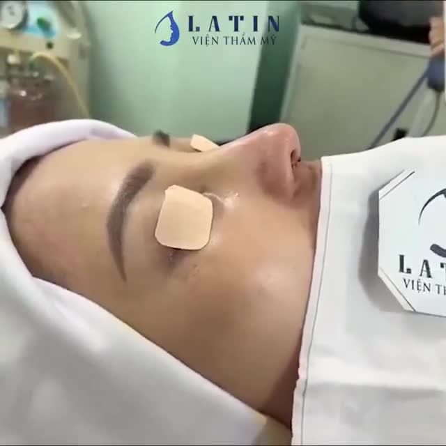 Kết quả ca mũi cấu trúc SỤN SƯỜN, Surgiform vừa hoàn thiện xong đẹp xuất sắc gửi đến cả nhà đây ạ!