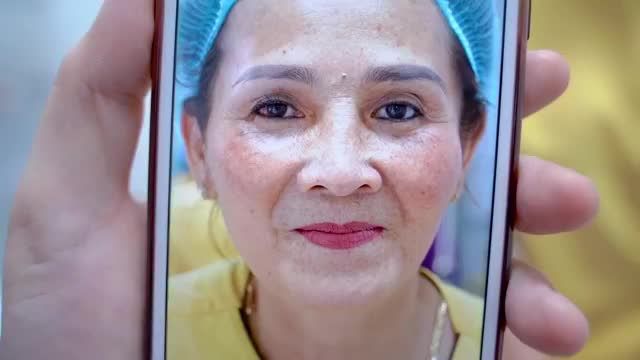 Kết quả nâng cung mày giúp vị khách hàng xóa bỏ da chùng sụp mí u buồn