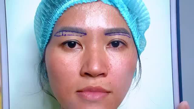 Kết quả Nâng cung mày trẻ trung rạng rỡ ngay sau khi thực hiện giải pháp vàng khắc phục sụp mí tuổi U30+