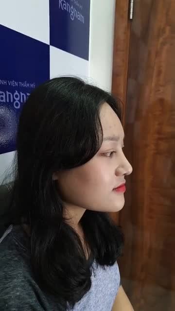 Kết quả sau 1 tháng Nâng mũi sline 4D chỉnh xương