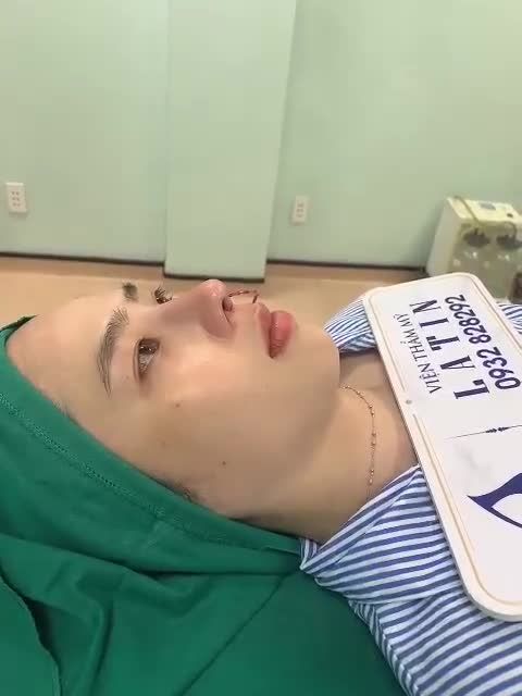 Kết quả thay đổi tuyệt vời cho bạn gái sau chưa đầy 2 tiếng nâng mũi cấu trúc surgiform chỉnh lệch.