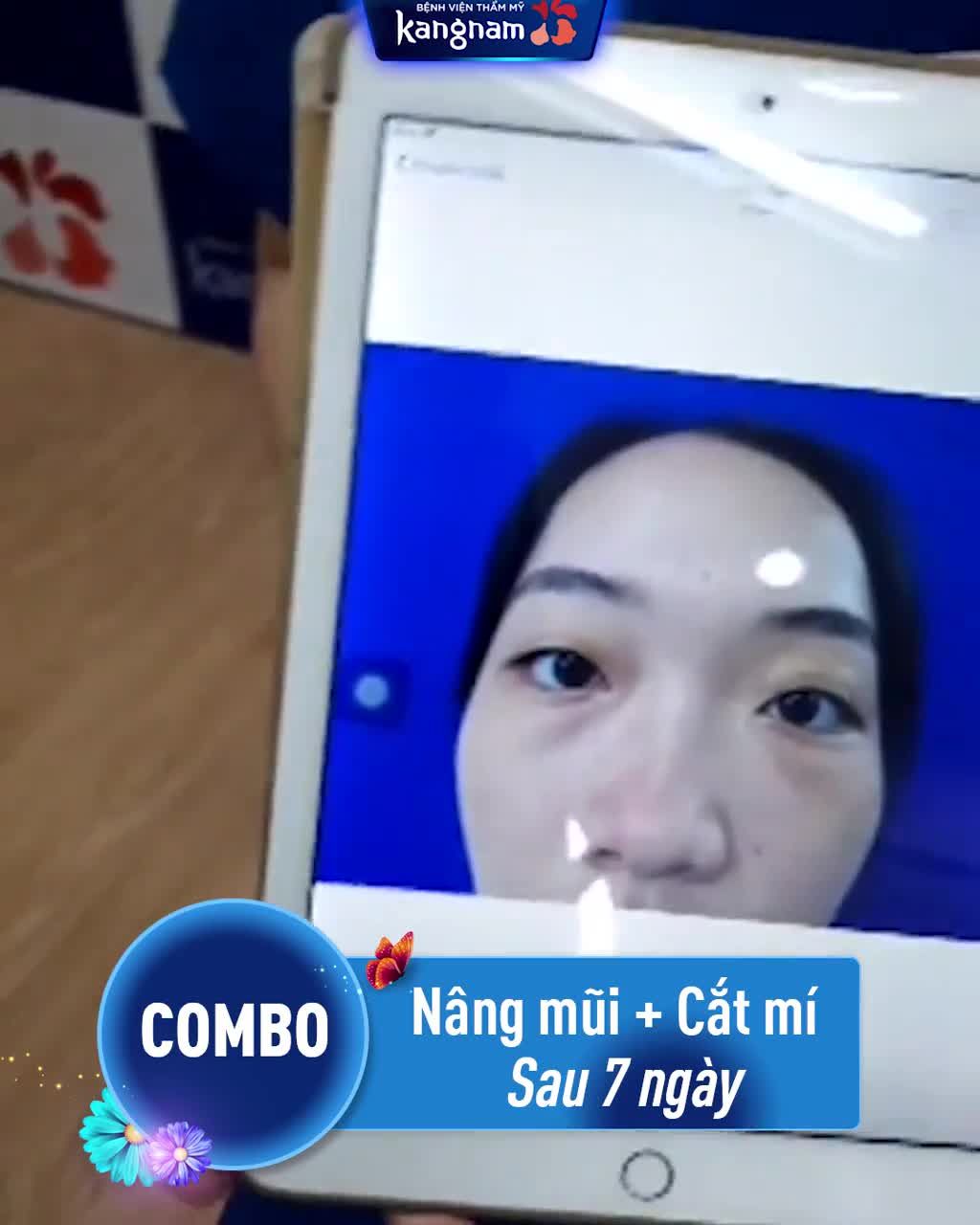 KH sau CẮT MÍ + NÂNG MŨI THẬT KHÓ TIN