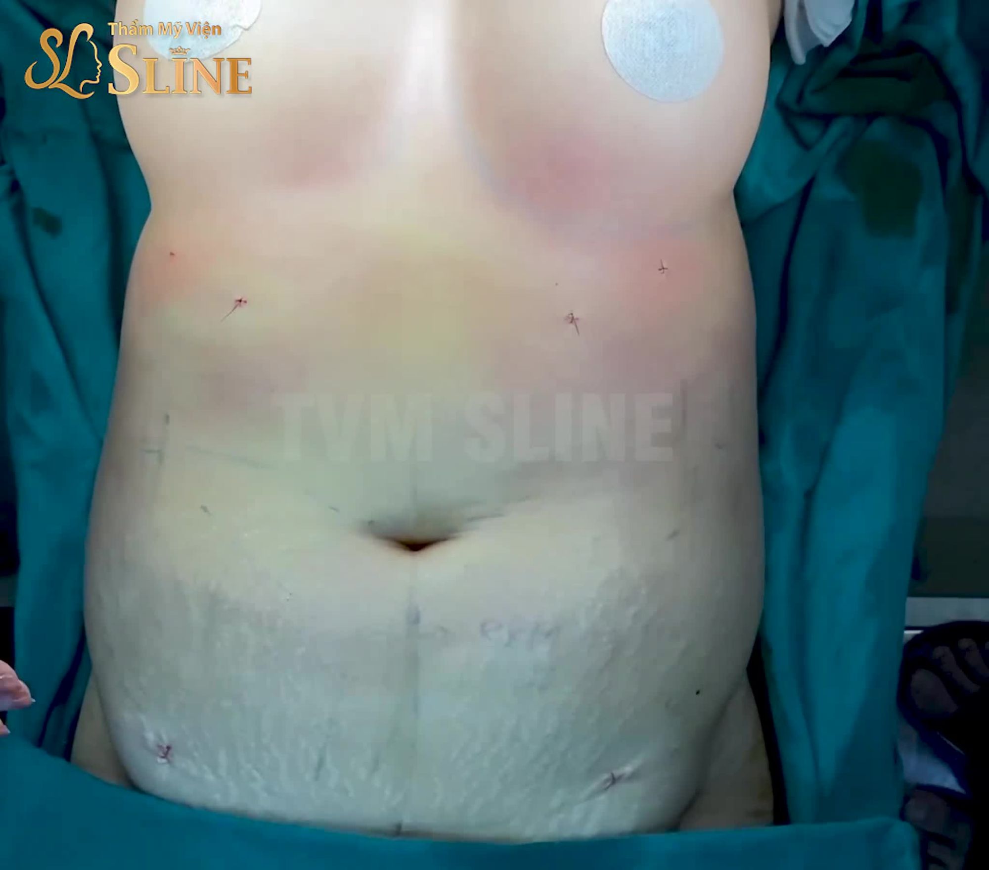 Khách hàng nâng cấp vòng 1 với dòng túi NanochipEG kết hợp hút mỡ bụng.