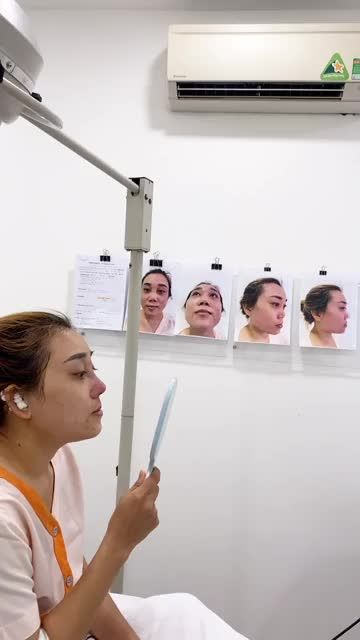Khách hàng nâng mũi nhân tạo nơi khác đã tháo sóng bị co rút sẹo đầu mũi nâng lại phương pháp cấu trúc sụn tai tại phòng khám AZ NOSE