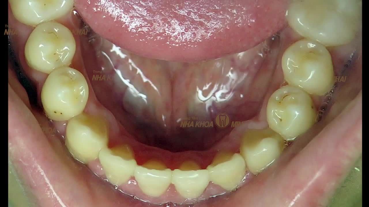 Khách hàng sinh năm 1999 đến phòng khám với mong muốn chỉnh răng đều để tự tin hơn trong công việc và cuộc sống.