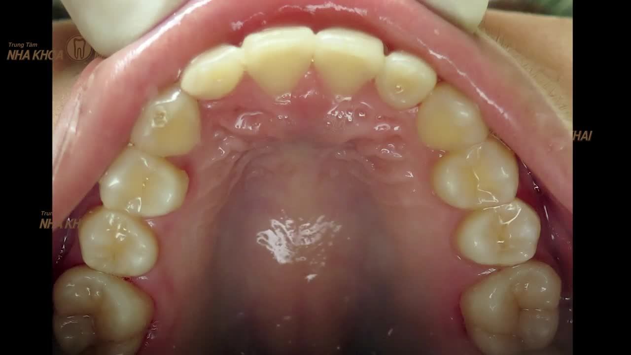 Khách hàng sinh năm 2002 đến với Nha Khoa Minh Khai với mong muốn chỉnh lại hàm răng lệch lạc.