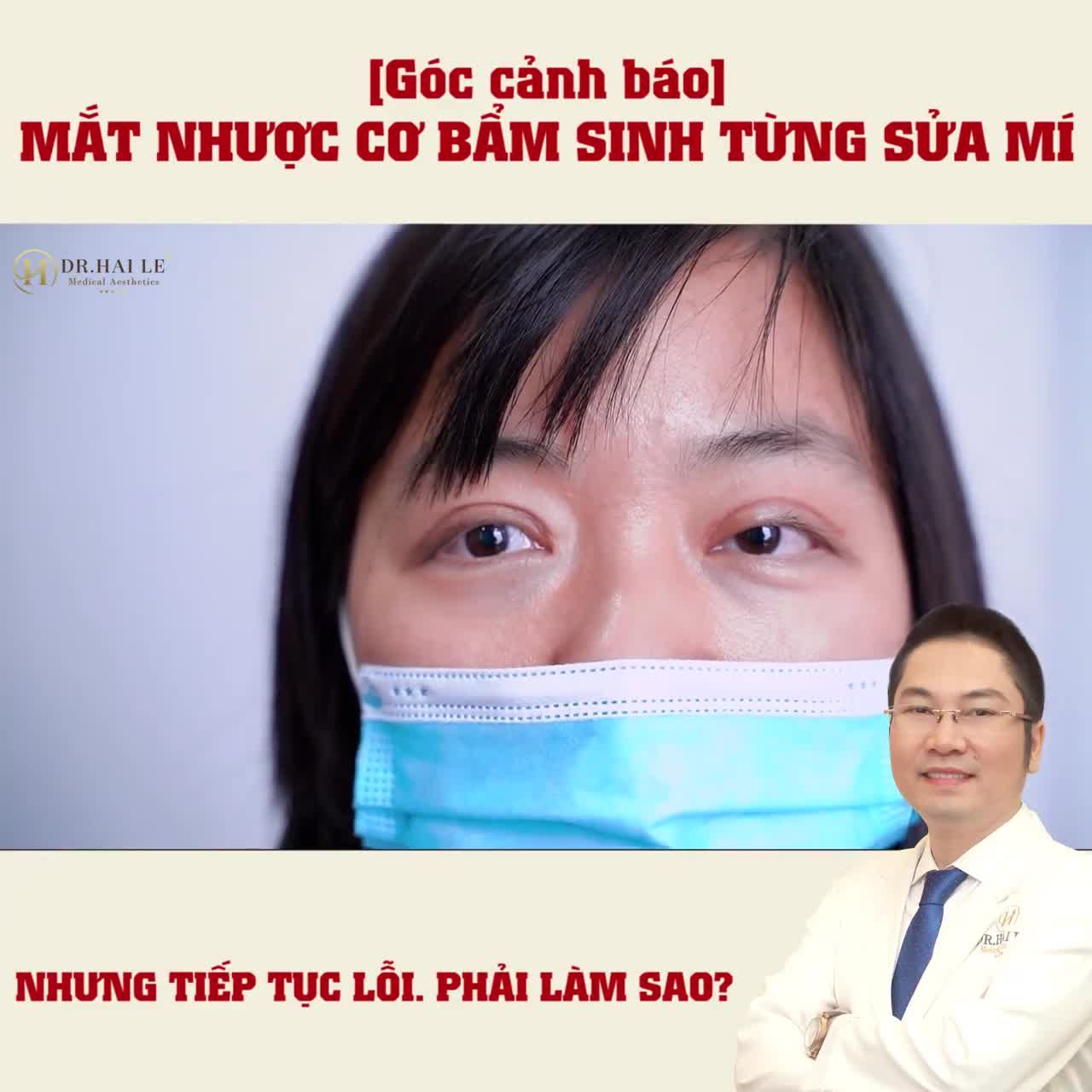 Khách hàng Thu Thủy chia sẻ về đôi mắt của mình: "Bị nhược cơ nâng mi bẩm sinh, nhưng không may mắn cắt mí sửa mí tại cơ sở không uy tín nên mí càng lỗi hỏng nhiều hơn.