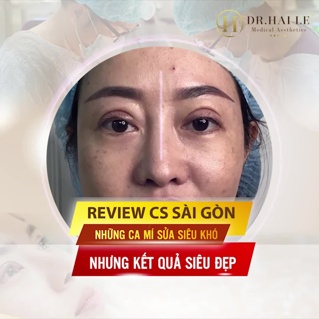Khi khách hàng muốn Dr.Hải Lê up nhiều review kết quả sửa mí Sài gòn nhiều hơn nữa Và đây là kết quả....