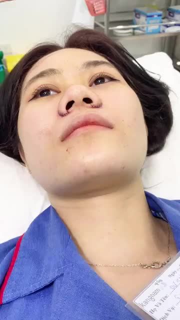 Khỏi Nâng Mũi khi CUỘN CÁNH MŨI đã CHUẨN như này