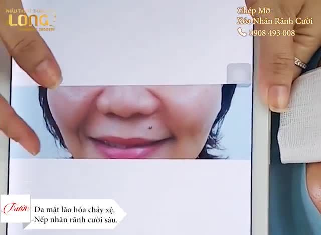 KHÔNG CẦN PHẪU THUẬT VẪN XÓA BAY NẾP NHĂN SÂU RÃNH CƯỜI