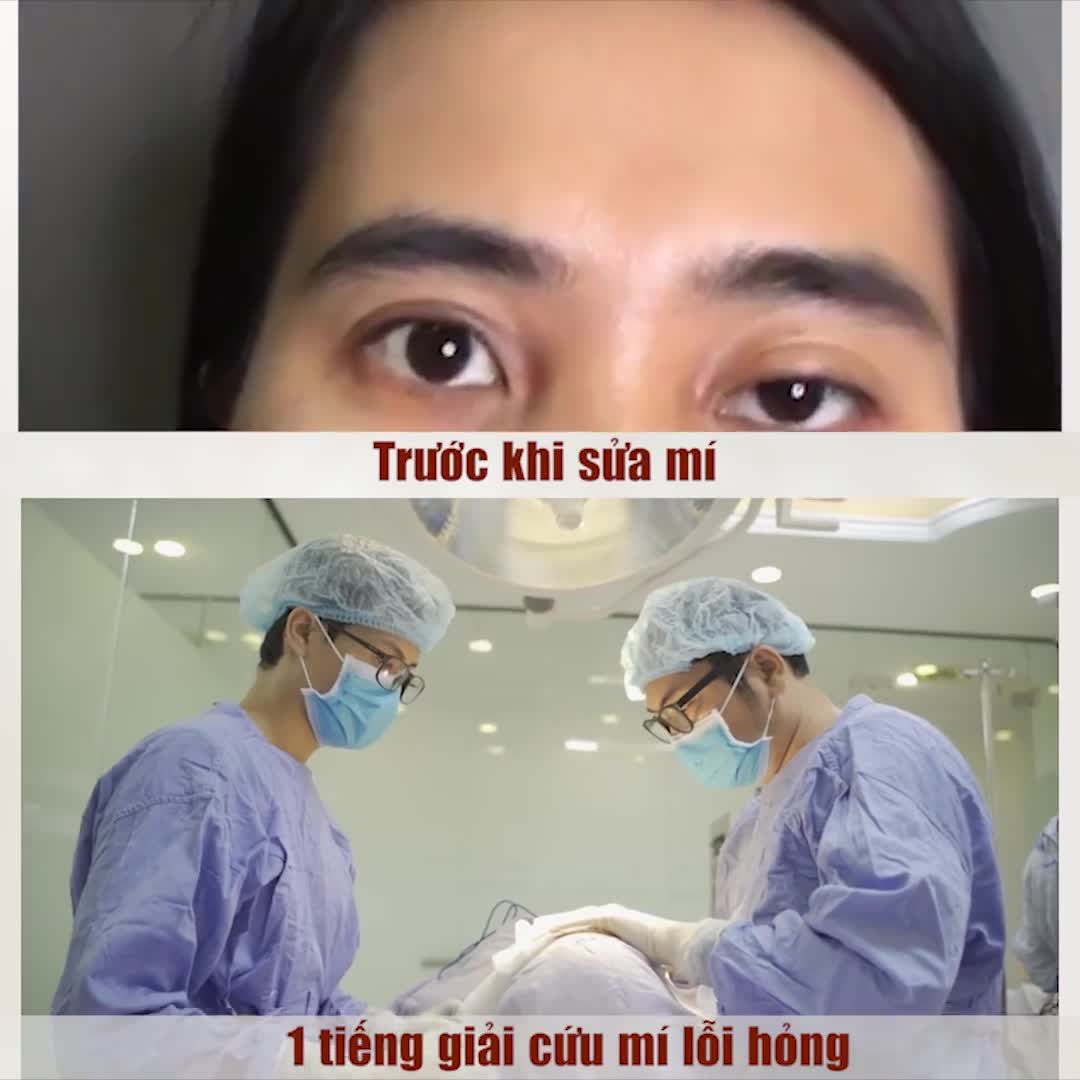 KHÔNG GÌ CÓ THỂ LÀM KHÓ DR.HẢI LÊ VỚI CÔNG NGHỆ SỬA MÍ DEEP TECH MED!