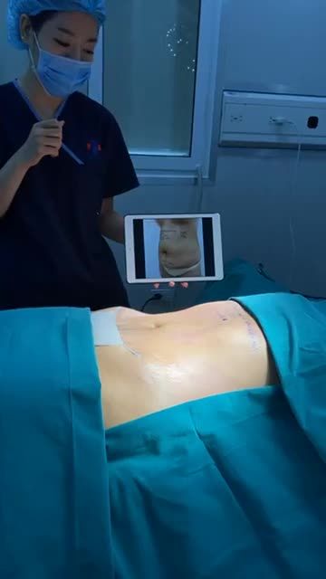 KIẾN TẠO VÒNG 2 THON GỌN CHO BÀ MẸ 3 CON Lấy lại vòng 2 thon nhanh gọn nhờ VASER LIPO