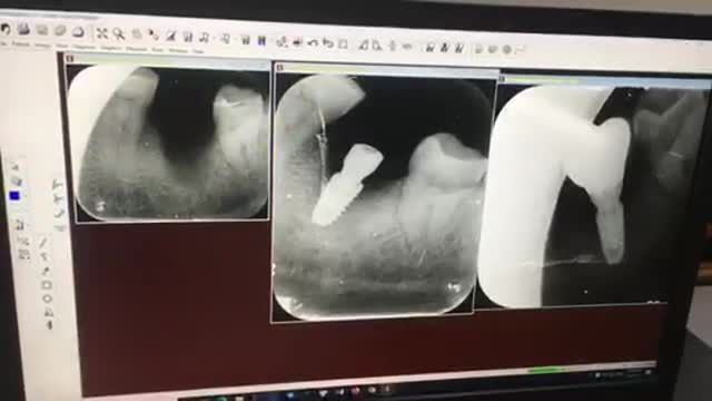 Lắp răng implant số 37 cho chú Hùng tại Nha Khoa Thuỳ Anh