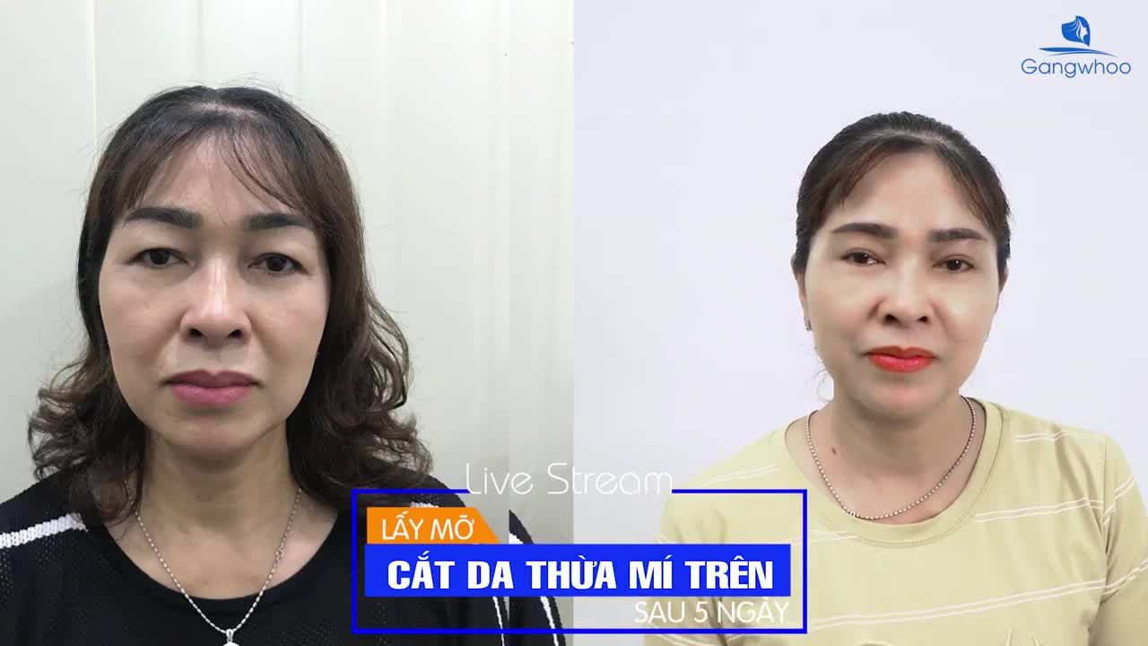 LẤY MỠ CẮT DA THỪA MÍ TRÊN SAU 5 NGÀY CÙNG KHÁCH HÀNG CỦA DR. PARK