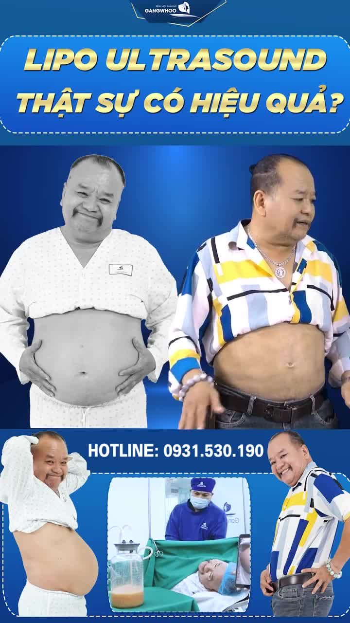 LIPO ULTRASOUND THẬT SỰ CÓ HIỆU QUẢ?