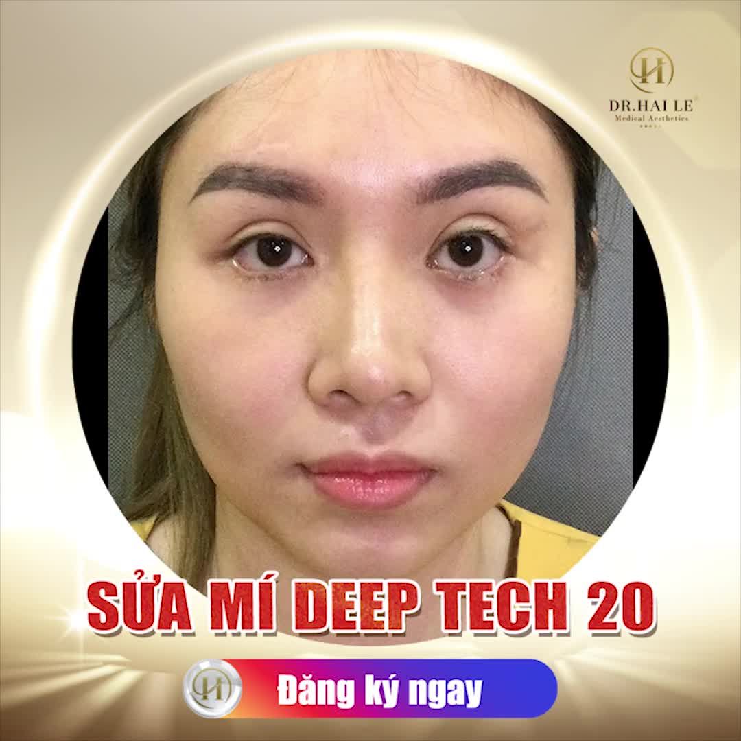 LỘT XÁC HOÀN HẢO - NHỜ SỬA MÍ DEEP TECH20