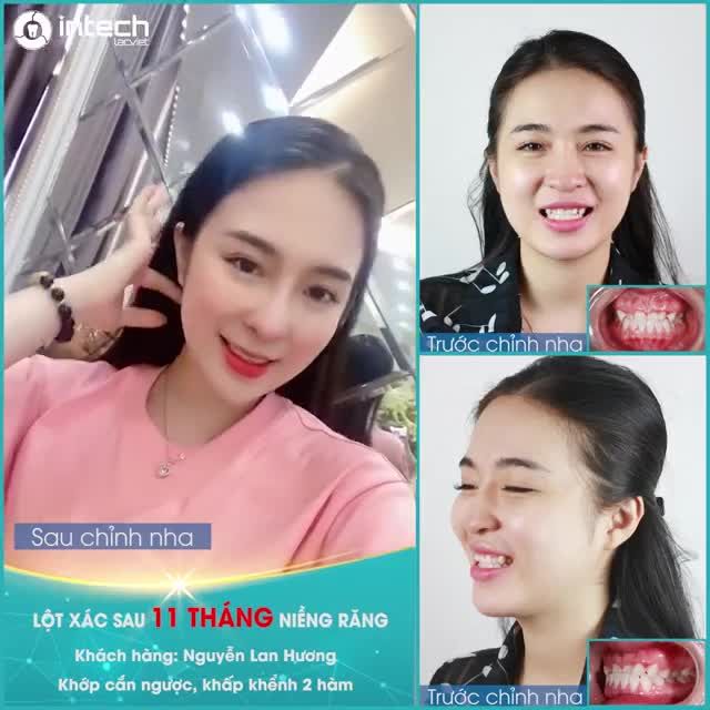 LỘT XÁC SAU 11 THÁNG NIỀNG RĂNG