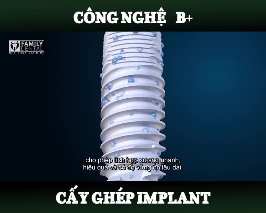 LÝ DO CHỌN CẤY GHÉP IMPLANT THAY THẾ RĂNG MẤT