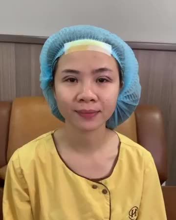 Mắt 1 mí khuyết mỡ "hô biến" 45 phút trở thành 2 mí rõ nét rạng rỡ Mời quý khách hàng cùng theo dõi